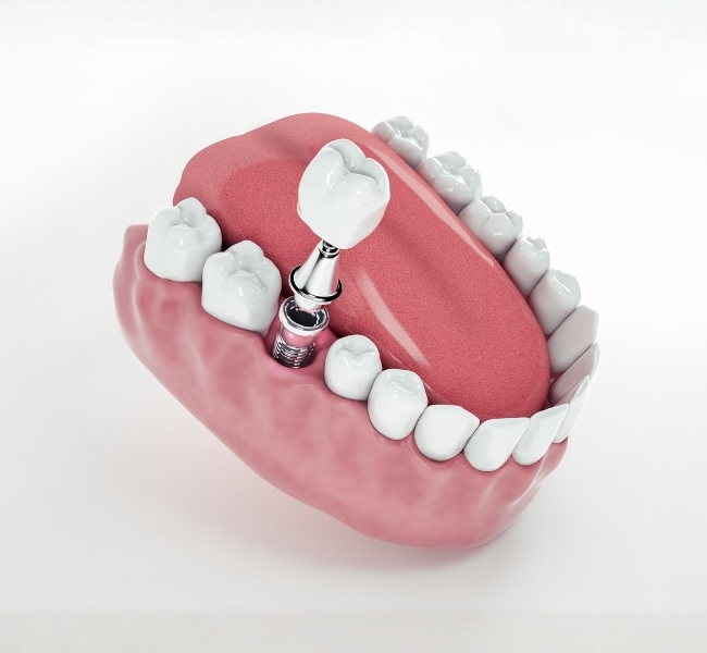 Modelo educativo de implante dentário mostrando estrutura e componentes do implante