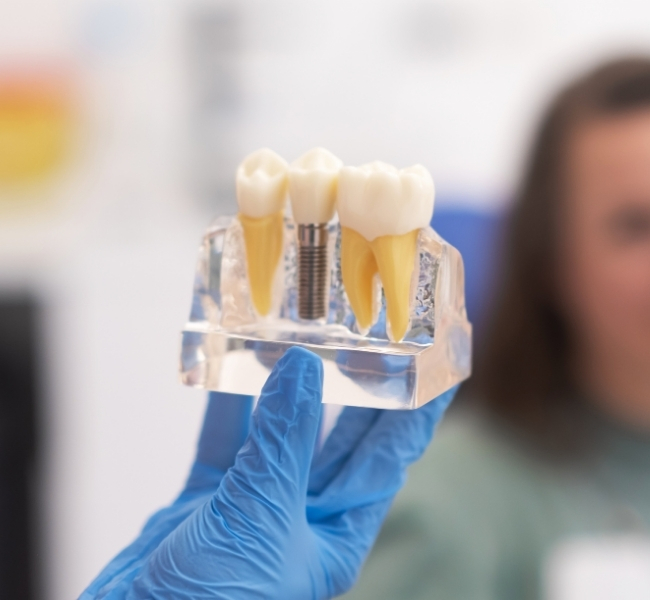 Modelo educativo de implante dentário mostrando os três componentes: dente natural, implante de titânio e coroa de porcelana