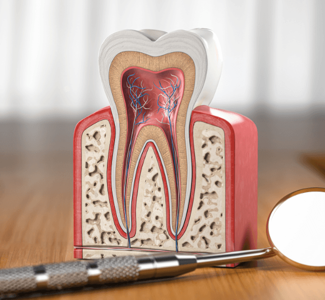 Modelo 3D educativo de dente mostrando a estrutura interna e a necessidade de tratamento de canal